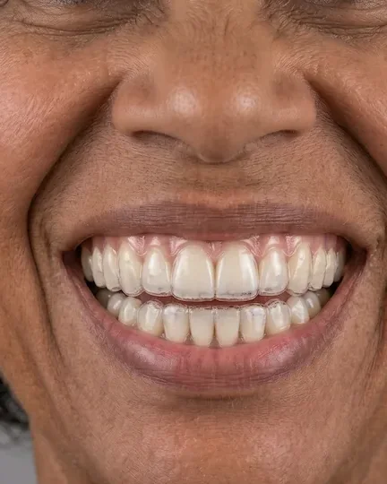 Sorriso com alinhadores transparentes (imagem ilustrativa)