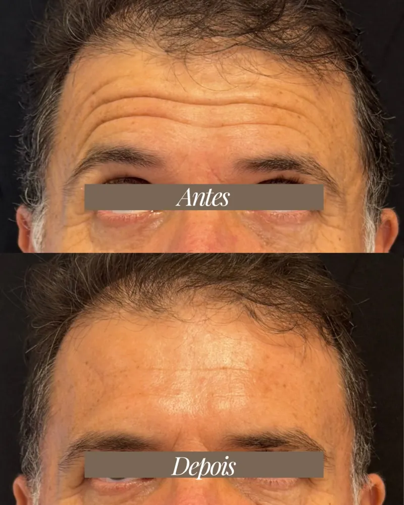 Antes e depois de toxina botulínica na testa: linhas de expressão suavizadas